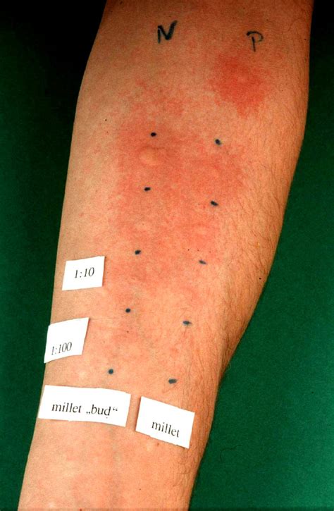 scratch test disease|positive skin prick test.